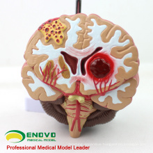 BRAIN10(12408) Medical Anatomical Brain Disease Model, Anatomical Model of Cerebral Artery Malformation